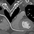Cardiac CTA Tools6